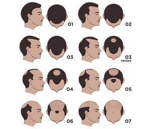 What is The Hamilton-Norwood Scale?
